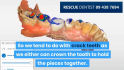 cracked-tooth-pain-requiring-dental-crown-in-whangarei-124x70