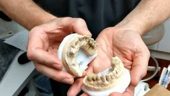 How Prosthodontist Dr Dennis Shepherd Restores The Teeth