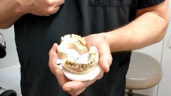 Prosthodontics Restored A Broken Set Of Teeth To Full Functionality