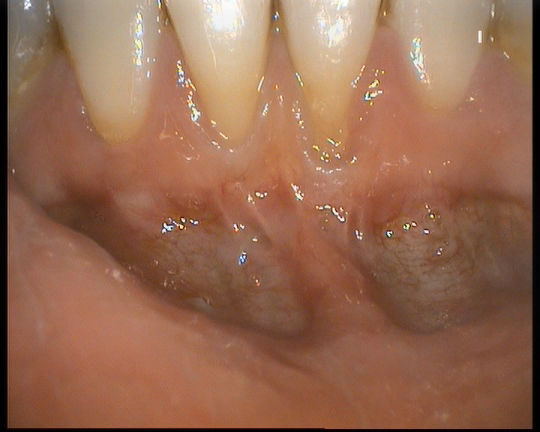 Gingivitis Showing Receding Gums & Exposed Tooth Root